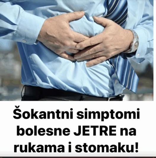 Šokantni simptomi bolesne JETRE na rukama i stomaku - featured image Šokantni simptomi bolesne JETRE na rukama i stomaku - featured image