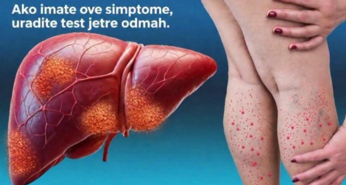 DA LI JE VAŠA JETRA U OPASNOSTI? Ovo je 12 ranih znakova ciroze jetre koje ne smete da ignorišete - featured image DA LI JE VAŠA JETRA U OPASNOSTI? Ovo je 12 ranih znakova ciroze jetre koje ne smete da ignorišete - featured image
